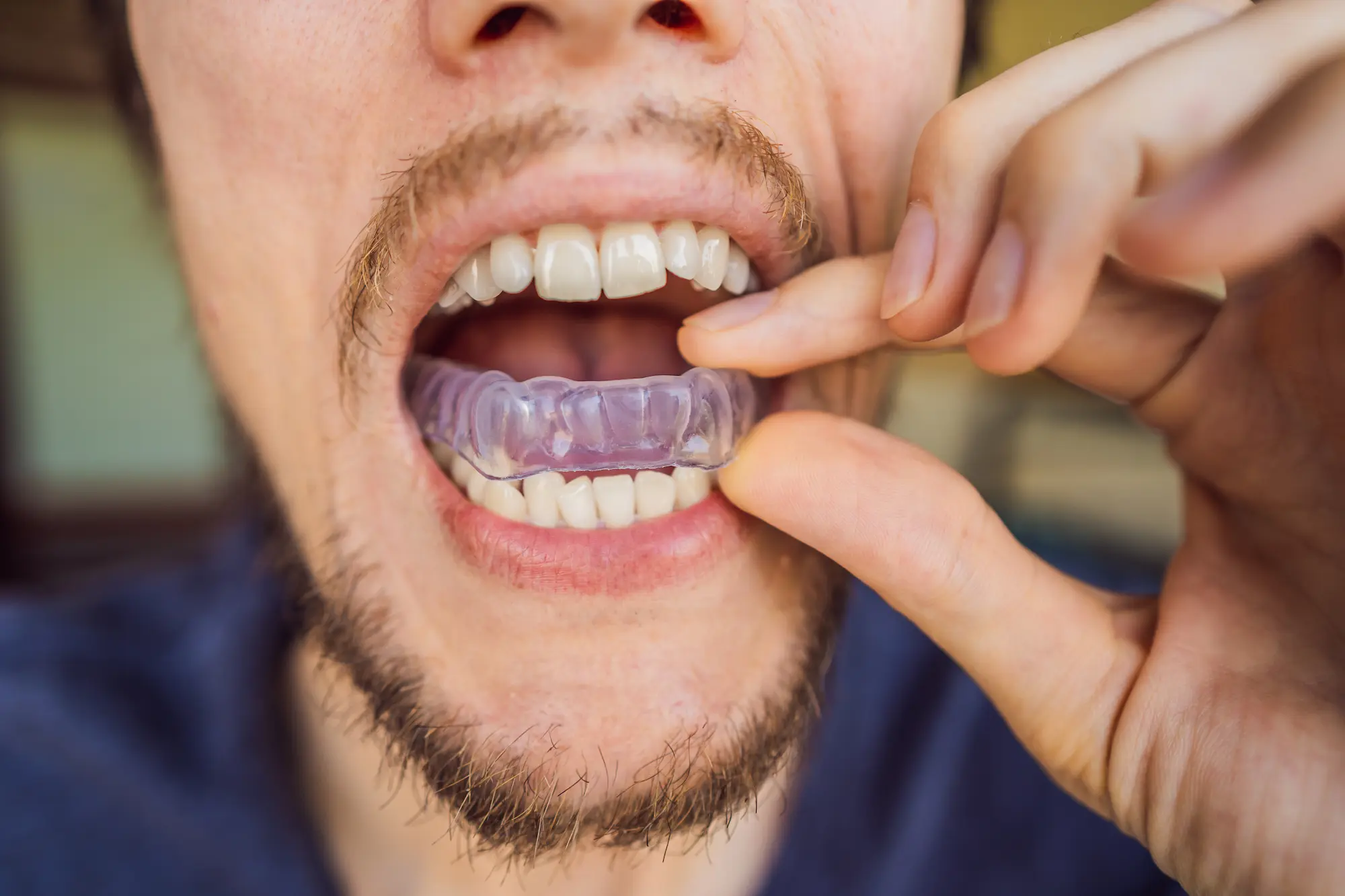 Occlusal and sports guard